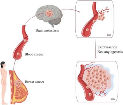 The role of irreversible pan-HER tyrosine kinase inhibitors in the treatment of HER2-Positive metastatic breast cancer